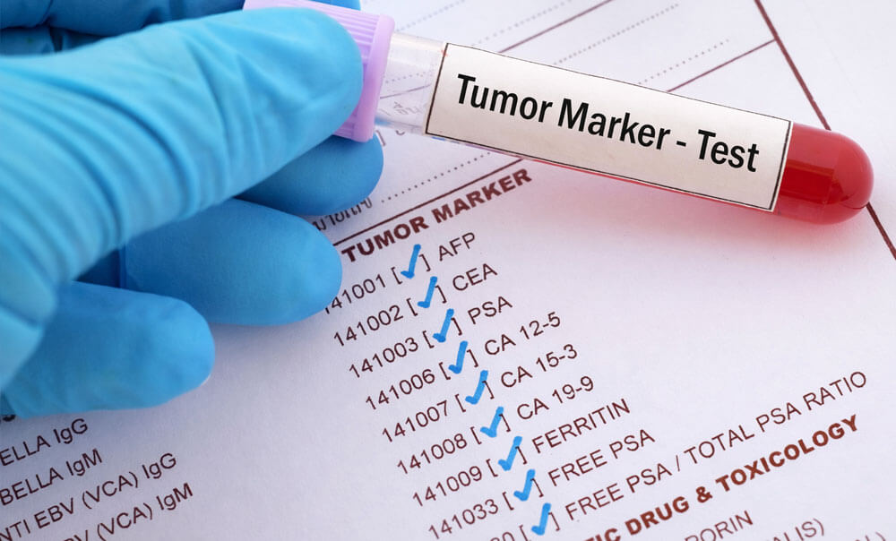Tumour Marker Tests