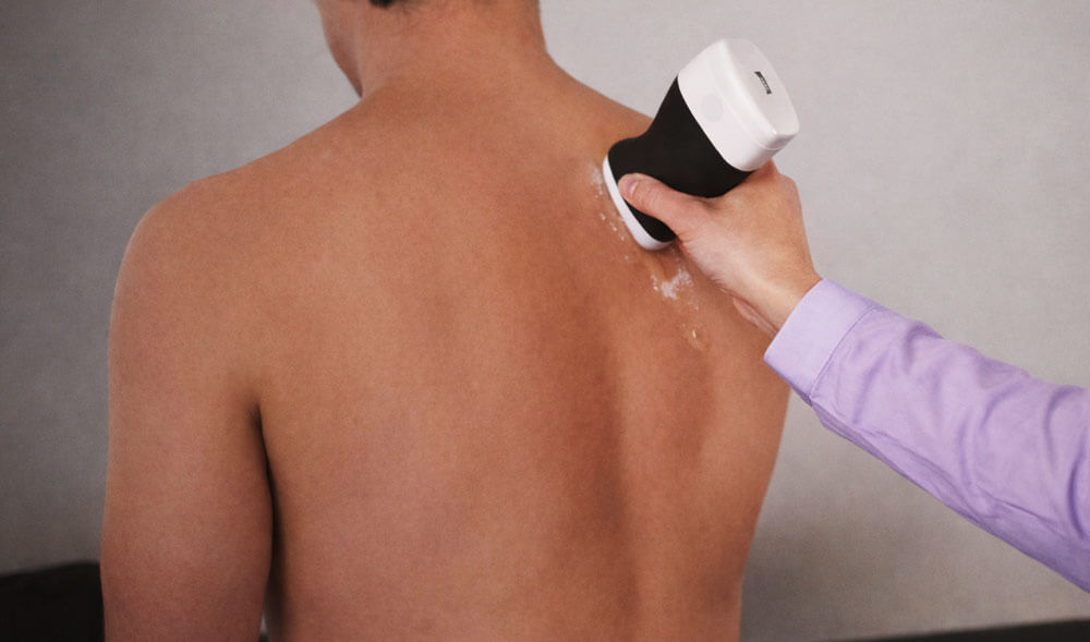 USG Guided Ascitic and Pleural Fluid Tap